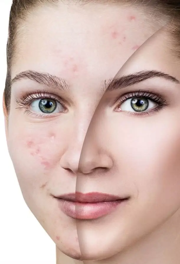 star aesthetic medical centre durban acne and acne scar treatment pick